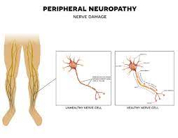 peripheral neuropathy can numb your