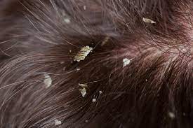 dandruff vs head lice lice clinics