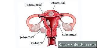 Check spelling or type a new query. Jenis Tumor Fibroid Perubatan 2021