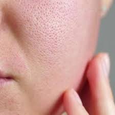 open pores treatment by dermatologist