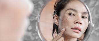 dark spots on your face