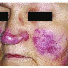 cutaneous lesions of sarcoidosis lupus