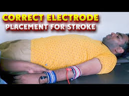 electrode placement for stroke patients