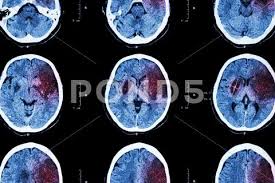 Some strokes, strokes or cerebral infarcts come suddenly without premonitory symptoms. Ischemic Stroke Ct Of Brain Show Cerebral Infarction At Left Frontal Temporal Parietal Lobe Nervous System Background Stock Images Page Everypixel