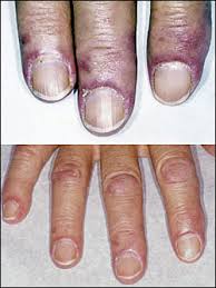 Maybe you would like to learn more about one of these? Nail Abnormalities Clues To Systemic Disease American Family Physician