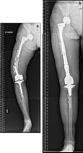 total knee and hip replacement