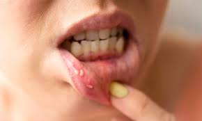 ayurveda to treat a painful mouth ulcer