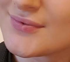 have scar tissue in lip caused by an