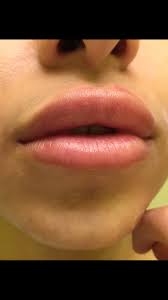 got juvederm filler in lips what are