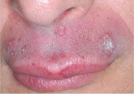 persistent swelling of the upper lip