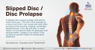slipped disc symptoms causes and
