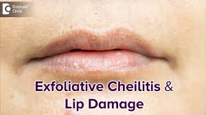 dry lips best treatment dr rasya dixit