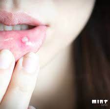 mouth ulcers origins causes how to