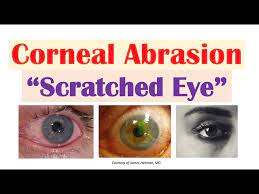 corneal abrasion scratched eye
