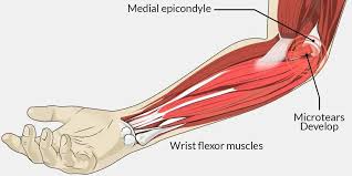 golfer s elbow causes symptons