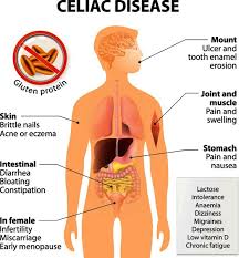 .diseases and their effect on different body functions, vaccination against infectious diseases v.helminthic diseases (i)ascariasis is caused by an intestinal endoparasite of human, ascaris from one part to other parts by the body fluids is called metastasis. Celiac Disease Medlineplus Genetics