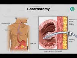 gastrotomy cpt code simplify cal