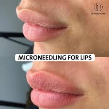 all about microneedling lips why it s