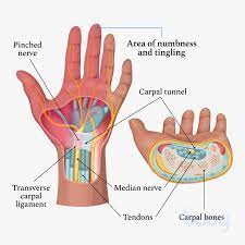 pinched nerve causes symptoms and