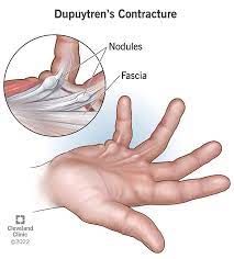 Dupuytren S Contracture Treatment gambar png