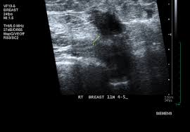 Advancements in technology may also mean breast cancer screening with ultrasound is an acceptable alternative for women in here are 5 expert tips to do right now. The Negative Mammogram Myth The Atlantic