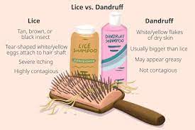 lice vs dandruff how to tell the