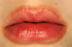 swollen lips 10 common causes what