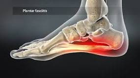 Image result for icd 10 code for plantar fascia tear left foot