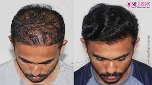 best hair transplant cost in jaipur