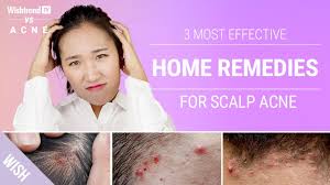 scalp back of neck acne naturally