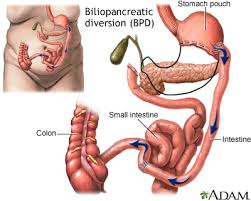 gastric byp surgery information