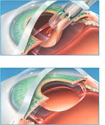 Learn about after cataract surgery recovery including cataract surgery recovery time and tips to get the best outcome by avoiding infections or complications. Cataract Surgery Gavin Herbert Eye Institute Cornea Surgery Refractive Surgery Glaucoma Pediatric Ophthalmology Retina Vitreous Neuro Opthalmology Orange County California