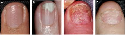 translated article nail psoriasis