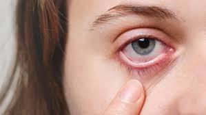 eye eczema what is eyelid dermais