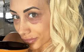 carmella shows off bruised face without