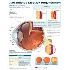 Age Related Macular Degeneration Chart Poster Laminated