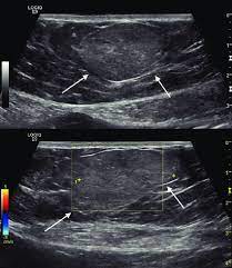 ultrasound scan uss of simple lipoma