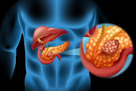 Pancreatic cancer arises when cells in the pancreas, a glandular organ behind the stomach, begin to multiply out of control and form a mass. Why Is Pancreatic Cancer So Hard To Treat Memorial Sloan Kettering Cancer Center