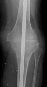 knee arthrodesis recon orthobullets