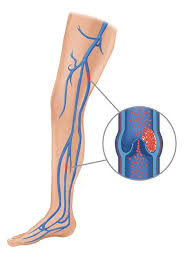 3 treating a blood clot in the leg. Deep Vein Thrombosis Orthoinfo Aaos