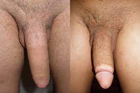 Dosya:Adult circumcision before and after (2).jpg - Vikipedi