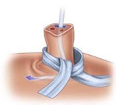 Umbilical Venous Catheter (UVC) Insertion and Management