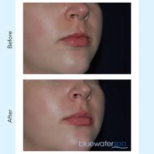 the botox lip flip blue water spa