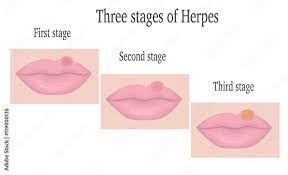 three ses of herpes simplex virus on
