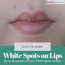 home remes to cure white spots on lips