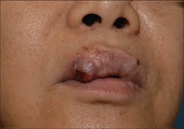 a protruding nodule on the upper lip