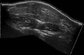 ultrasound of soft tissue mes