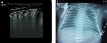 Respiratory distress syndrome (rds) is a relatively common condition resulting from insufficient production of surfactant that occurs in preterm neonates. Grade Ii Rds Open I