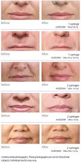 dermal fillers juvederm ultra plus xv