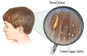 head lice monomoy regional